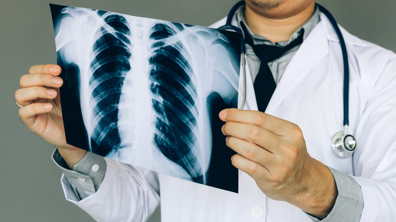 Luxación de costillas